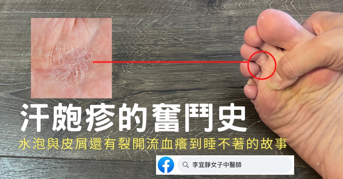 【汗皰疹全攻略】從照顧到調理的奮鬥史