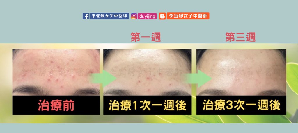 痘痘微針治療前後對照 額頭在治療前、治療1次與3次後的變化