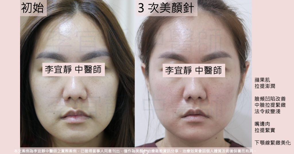 美顏針前後對照,三十歲女性連續三週三次療程後,中臉與嘴邊肉拉提