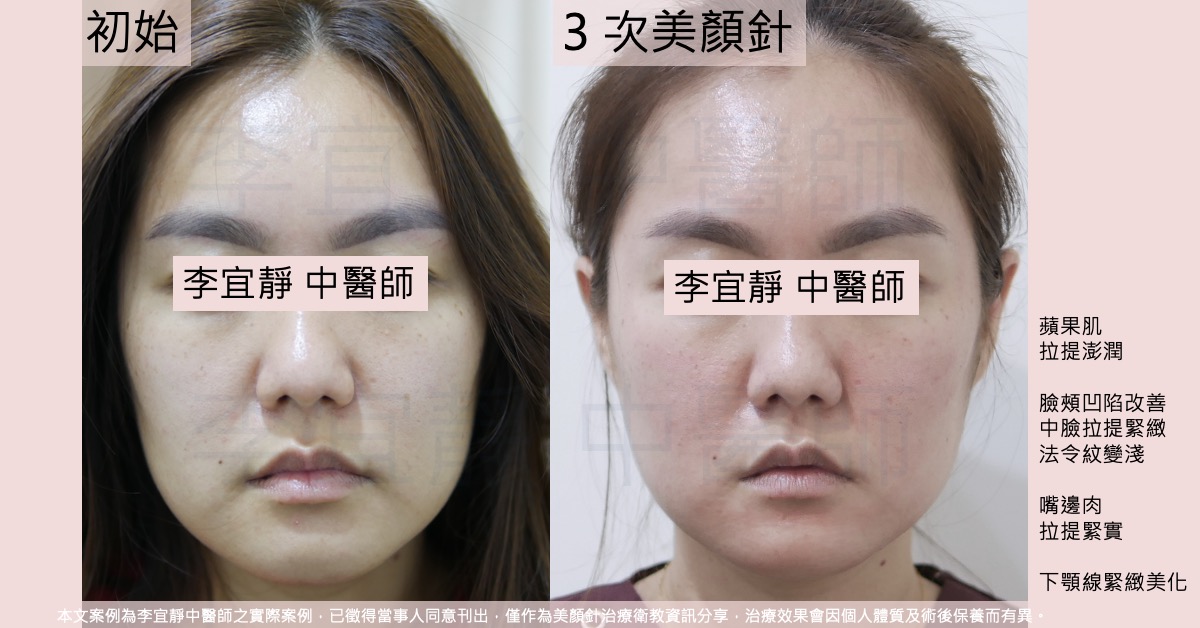 美顏針前後對照,三十歲女性連續三週三次療程後,中臉與嘴邊肉拉提