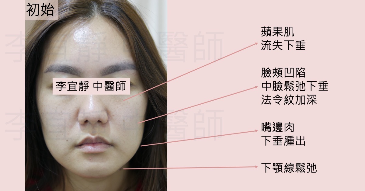 三十歲女性美顏針療程前,中臉下垂與嘴邊肉標註圖