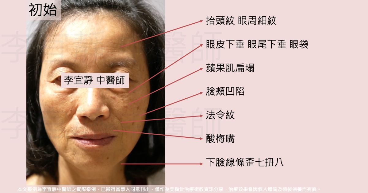 六十五歲女性美顏針療程前標註圖,眼皮下垂與細紋