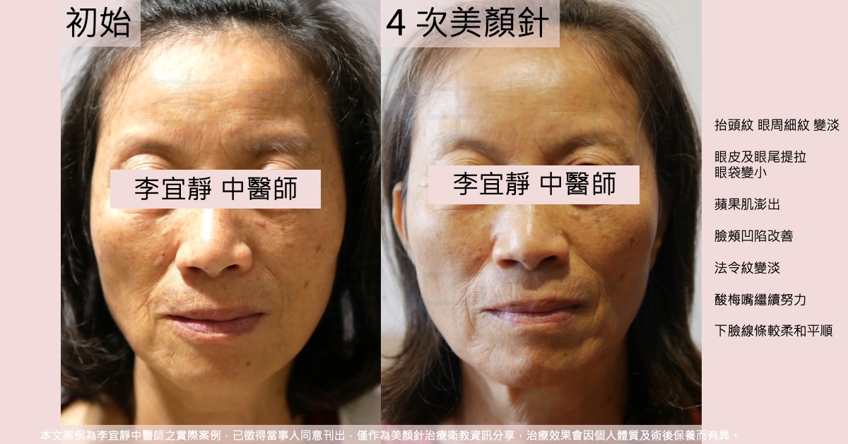 六十五歲女性美顏針四次療程前後對照