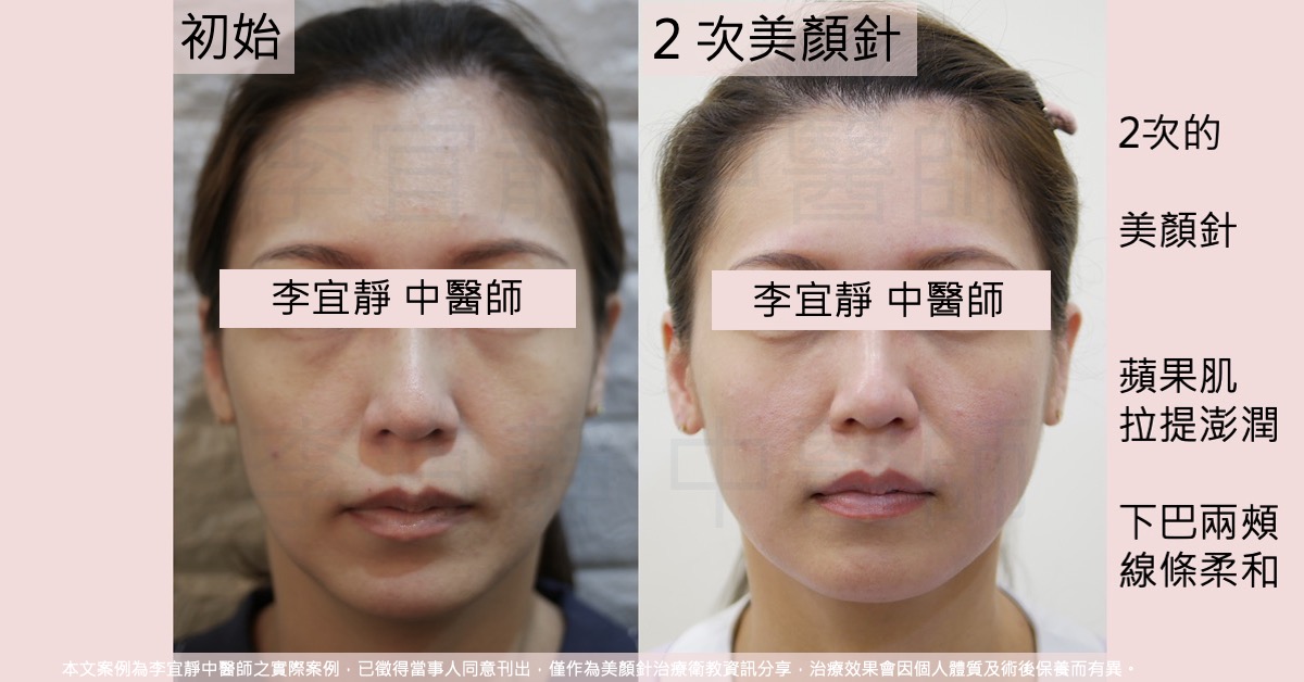 瘦型緊繃臉部美顏針兩次療程前後對照
