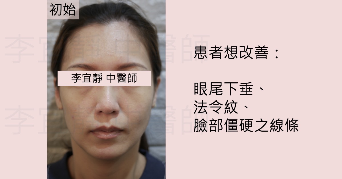 瘦型緊繃臉部美顏針療程前