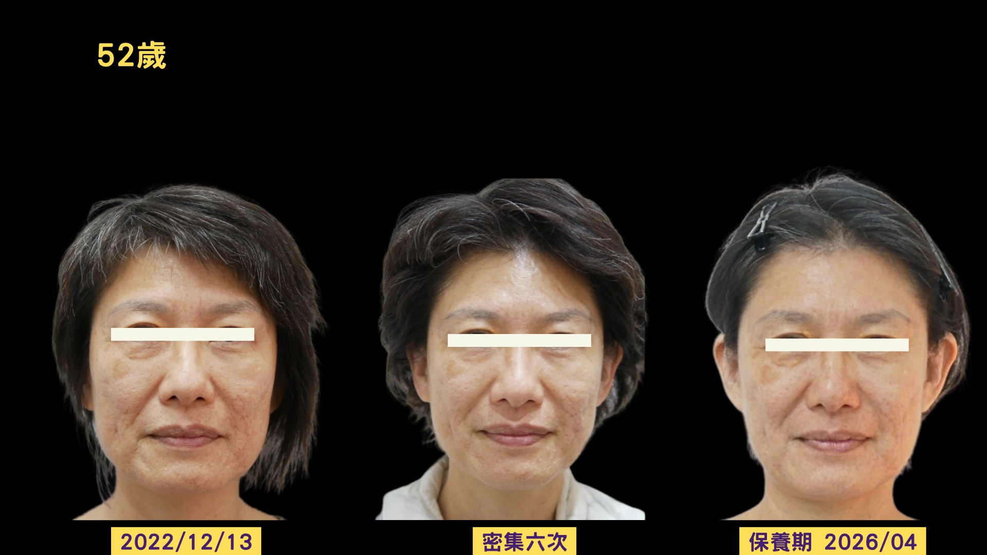 美顏針保養期三年多追蹤三格對照