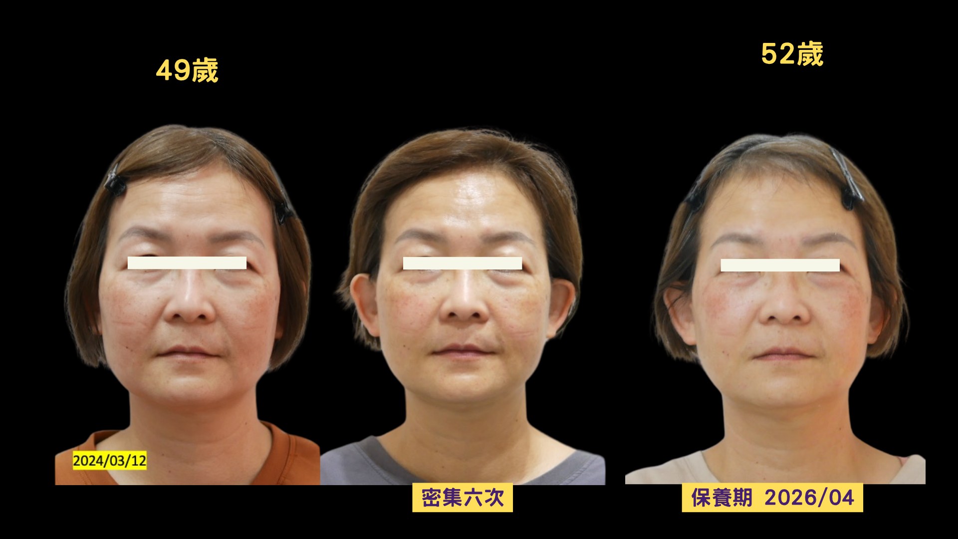 美顏針保養期兩年追蹤三格對照