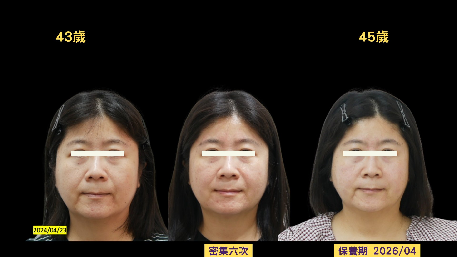 木偶紋美顏針兩年追蹤三格對照